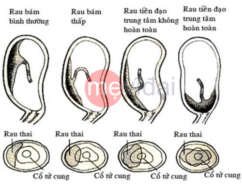 Nguyên nhân hiện tượng ra máu khi mang thai 
