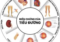 biến chứng tiểu đường