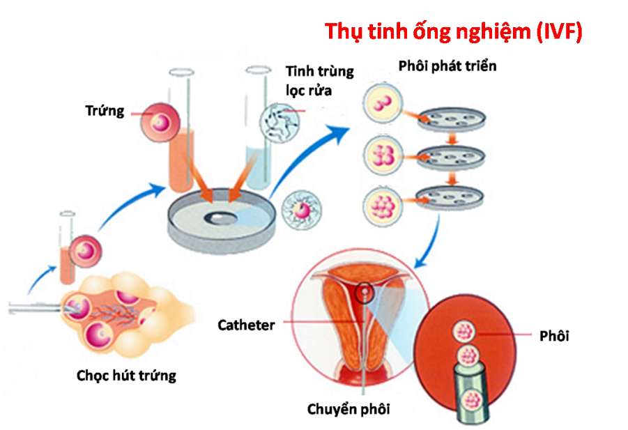 Thụ tinh trong ống nghiệm là kỹ thuật có tỷ lệ thành công cao