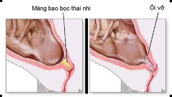dấu hiệu chuyển dạ con so