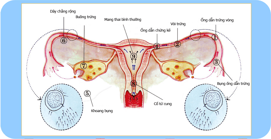 Mang thai ngoài tử cung gây ra mau khi mang thai