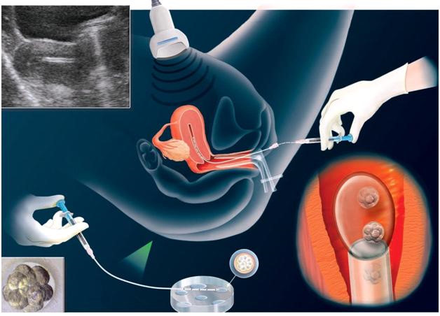 Tinh trung và trứng gặp nhau và được nuôi cấy trong ống nghiệm trước khi bơm vào tử cung