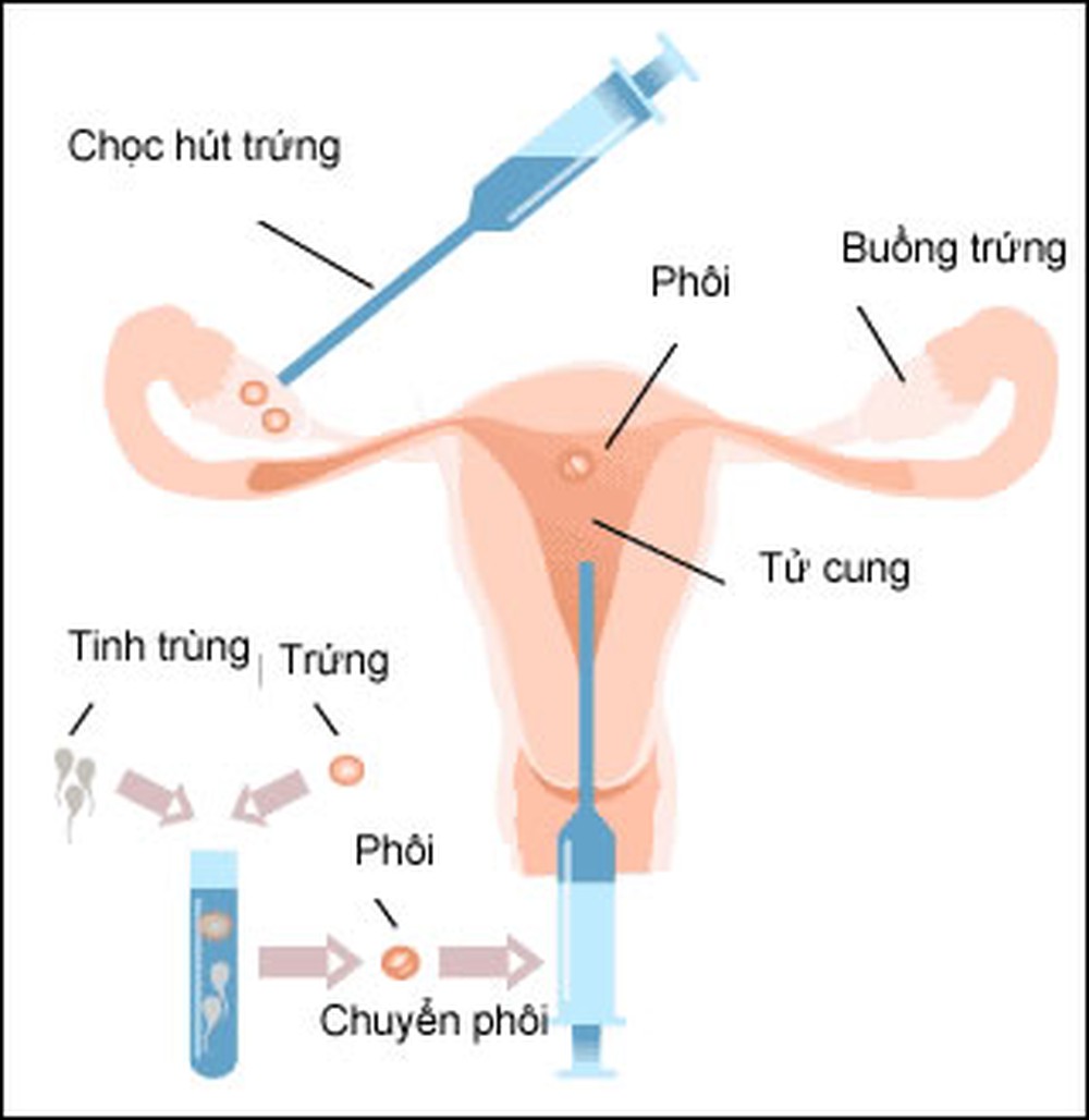 thụ tinh trong ống nghiệm các cặp vợ chồng cần thực hiện chuẩn bị tốt