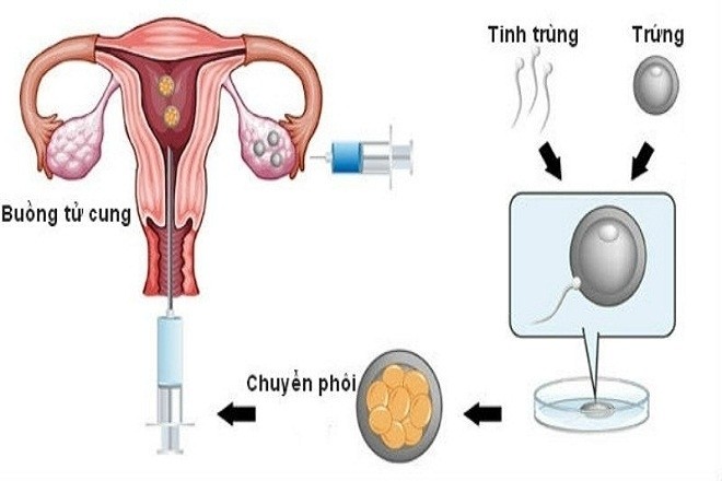 Trứng được  lấy xong thụ tinh trong ống nghiệm