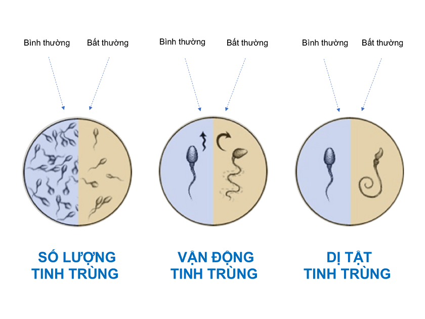 tinh trùng bất thường gây vô sinh