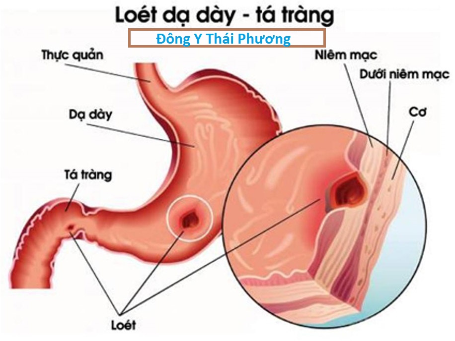 viêm loét dạ dày tá tràng