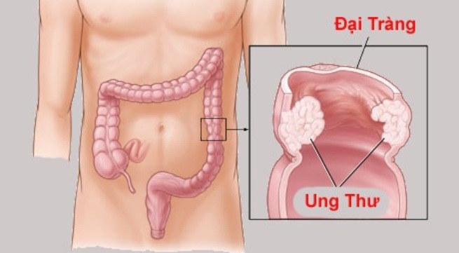 Ung thư đại tràng là căn bệnh vô cùng nguy hiểm