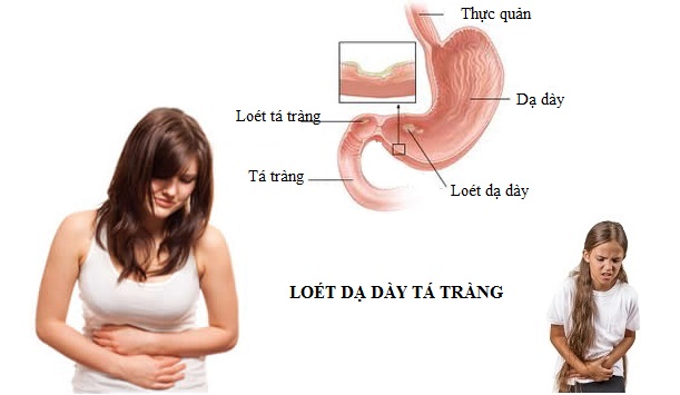 viêm loét dạ dày tá tràng